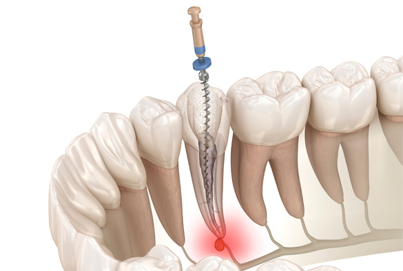 Graphic of an endodontic treatment